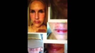 Carac Flourouracil Topical Chemotherapy Treatment on Lips [upl. by Tolland419]