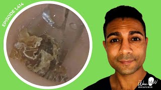 1414  Extreme Pruritus Dead Skin Keratin Removal  Read BSHAA Reply [upl. by Drehcir]