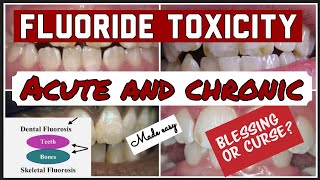 FLUORIDE TOXICITY II ACUTE AND CHRONIC II DENTAL FLUOROSIS II PUBLIC HEALTH DENTISTRY [upl. by Melentha]