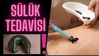 Sülük tedavisi öldürebilir ‼️sülük tedavisi nasıl yapılırsülük tedavisi faydaları [upl. by Ladonna]