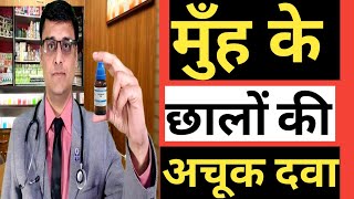 MOUTH ULCERS APHTHAE  मुँह के छालों की अचूक दवा  HOMEOPATHIC TREATMENT [upl. by Alroi]