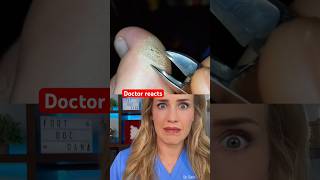 Doctor reacts foot callus art [upl. by Noman]