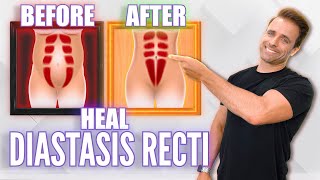 5 Advanced Diastasis Recti Exercises  Postpartum Deep Core Workout [upl. by Nyladnohr]