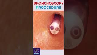 Bronchoscopy Procedure education shorts [upl. by Yenar540]