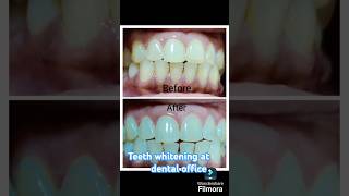 Teeth whitening in the Dental office by Dr Aftab jahan smile designing dentist teeth whitening [upl. by Leryt]