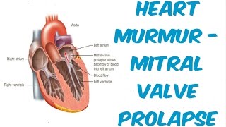 Mitral Valve Prolapse  Auscultation Sound [upl. by Per]