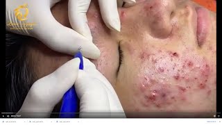 Treatment of acne tablets pustules and blackheads 359  Loan Nguyen [upl. by Atsirc824]