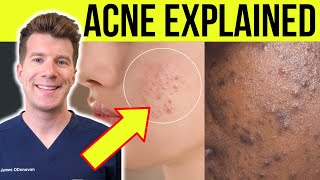 Doctor explains ACNE  Causes symptoms treatment and more [upl. by Ahseket]