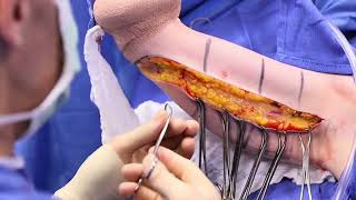 Surgical Video Female Patient Gets Skinny Arms with a Brachioplasty [upl. by Halle]