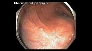 Colonoscopy Channel  EMR of LSTNG tumor  6 months followup [upl. by Alameda907]