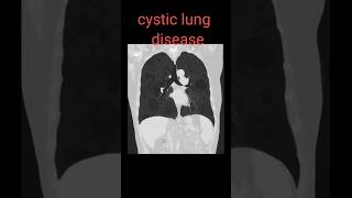 cystic lung disease shorts radiology lungsdisease radiologyjunction [upl. by Maggio]