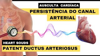 AUSCULTA PERSISTÊNCIA DO CANAL ARTERIAL PCA Patent ductus arteriosus heart murmur PDA [upl. by Notsyrb595]