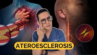 ATEROESCLEROSIS todo lo que debes saber  Dr William Guerrero [upl. by Ellasal]