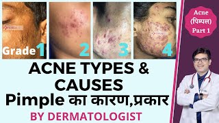 Acne Types and Causes In Hindi  Acne Types with Pictures  Pimple Ke Prakar  Dr Sunil [upl. by Swirsky802]