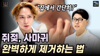 이것만 바르면 쥐젖 사마귀 똑 떨어진다고 강남 피부과 원장이 알려주는 쥐젖 사마귀 확실하게 없애는 방법 [upl. by Llehsal]