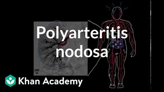 Polyarteritis nodosa  Circulatory System and Disease  NCLEXRN  Khan Academy [upl. by Ilsel]