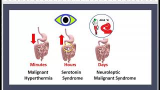 Le Syndrome Malin des Neuroleptiques Antipsychotiques Antidepresseurs Sérotonine Pharmacologie 3 mn [upl. by Matland]