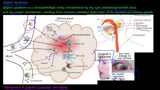 101P  What is Sjögren Syndrome [upl. by Sabra295]