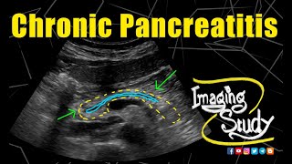 Chronic Pancreatitis  Ultrasound  Case 168 [upl. by Assedo571]