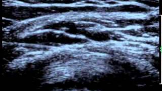 Shoulder Bursitis Ultrasound Guided Injection [upl. by Yclehc]