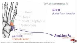 5th Metatarsal Fractures [upl. by Lapointe61]