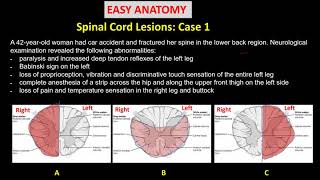 Spinal Cord Lesions Case1 [upl. by Anders]