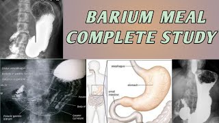 Barium Meal Complete Study Of Stomach [upl. by Ycal]