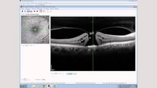 Case Study with SPECTRALIS OCT Macular Hole [upl. by Nylirret]