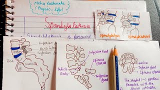 Spondylolisthesis  PathologyTypesDiagnosisTreatment [upl. by Nadab]