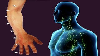 Lymphangitis Causes And Symptoms [upl. by Borries]