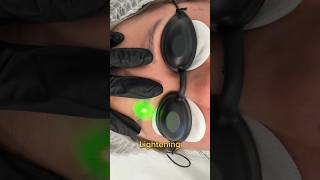 Laser PMU eyebrows removal [upl. by Treblih]