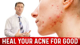 What Causes Pimples and How to Get Rid of Acne [upl. by Erskine]