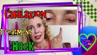 Chalazion Treatment Hack [upl. by Annie286]