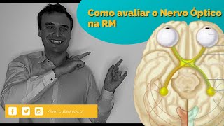 Como avaliar o nervo óptico na RM [upl. by Yrac]