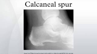 Calcaneal spur [upl. by Nylodam]