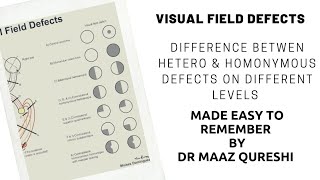 LESIONS OF VISUAL PATHWAY  SCOTOMAS EXPLAINED Junctional scotoma HOMONYMOUS HEMIANOPIA [upl. by Balbur]