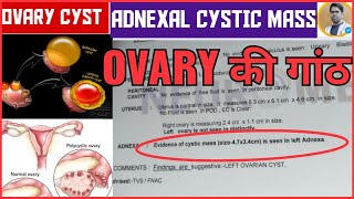 OVARIAN CYST IN HINDIADNEXAL CYST और OVARIAN CYST मैं क्या अन्तर होता हैOVARY मैं गांठ होना [upl. by Adrea436]