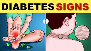 Diabetes Symptoms  Diabetes Mellitus  Type 2 Diabetes  Signs amp Symptoms  Diabetes Warning Signs [upl. by Howe395]