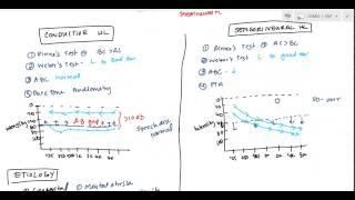 Conductive and Sensorineural Hearing Loss Deafness for USMLE [upl. by Furlong]