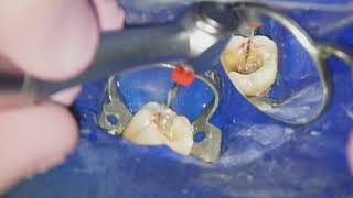 Endodontiste Hugo Setbon  Le retraitement endodontique [upl. by Auberbach]