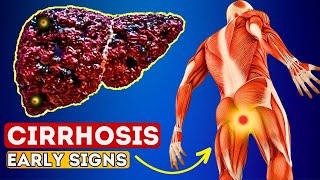 12 Early Signs of Liver CIRRHOSIS  LIVER is DYING [upl. by Asyla]