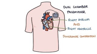 Understanding Pacemakers [upl. by Tiena]