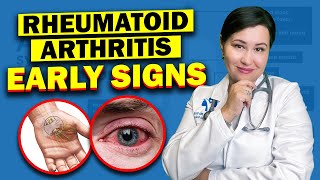 Early Warning Signs Of Rheumatoid Arthritis  Dont Ignore These Vital Symptoms [upl. by Hogg]