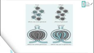 Glomerulonephritis [upl. by Kantor]