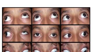 Evaluation of Restrictive Strabismus [upl. by Eesac]