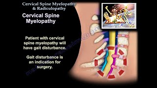 Cervical Spine Myelopathy amp Radiculopathy  Everything You Need To Know  Dr Nabil Ebraheim [upl. by Hoi]