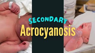 Secondary Acrocyanosis in a Newborn Baby [upl. by Lesly668]