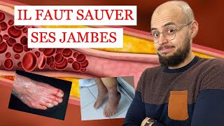 ARTÈRES des jambes BOUCHÉES et ULCÈRE de la PEAU ce quil faut savoir [upl. by Aeresed]