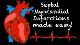 EMS Cardiology  Tachy Tuesday Septal Myocardial Infarctions in EMS [upl. by Darrin]