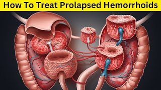 How To Treat Prolapsed Hemorrhoids  How To Treat Prolapsed Hemorrhoids At Home [upl. by Larred]